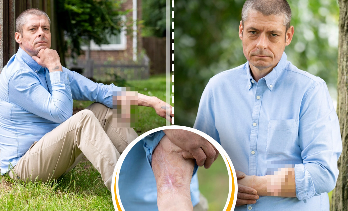 Hombre pierde su miembro por una infección en la sangre y se lo reconstruyen en el brazo